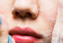 داغون شدن صورت با پد ! پد اصل