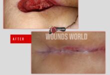 درمان زخم بستر